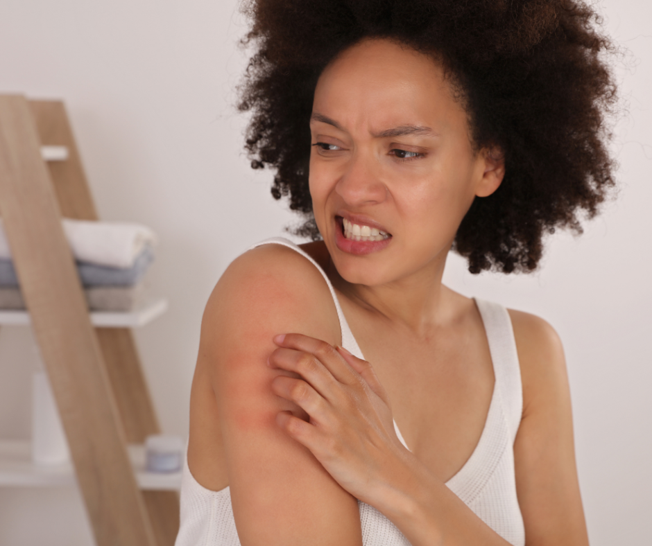 How to Fight Eczema Flare Ups
